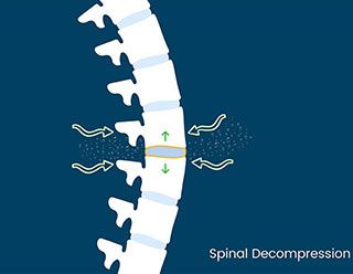 What is Spinal Decompression